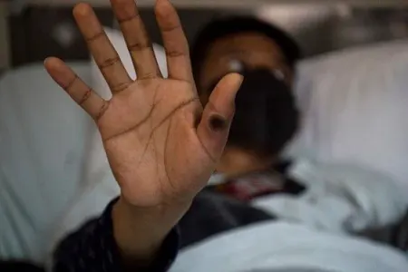 Meymunçiçəyi virusu Avropaya yayıldı: - İsveç ilk yoluxmanı açıqladı