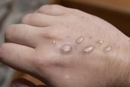 Azərbaycana meymunçiçəyi virusunun müayinəsi üçün testlər gətirildi