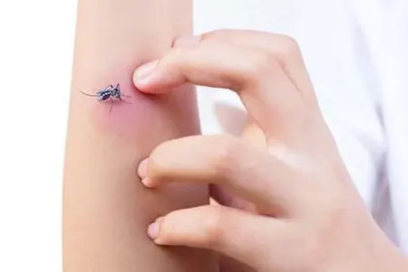 Həşərat dişləmələri bu halda çox təhlükəli ola bilər.. - Mütəxəssis