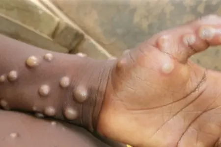 Meymunçiçəyi İrana ÇATDI? - Rəsmi açıqlama