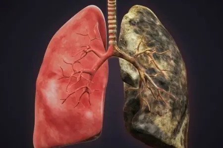 Ağciyər xərçənginə qarşı - VAKSİN