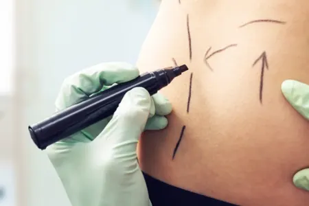 Liposaksiya əməliyyatı sağlamlığına - ZİYAN VURDU