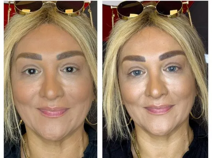 Aparıcı Mətanət əməliyyatla göz rəngini dəyişdirdi - Fotolar