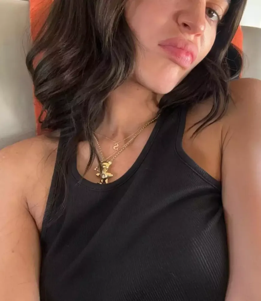 Dodağındakı dolğuları çıxarıb yeni - FOTOsunu paylaşdı