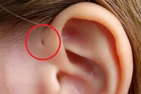 Çox insanda rast gəlinən bu çuxur nədir? - FOTO