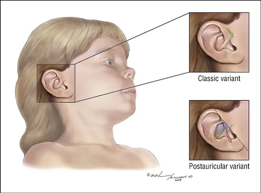 Çox insanda rast gəlinən bu çuxur nədir? - FOTO