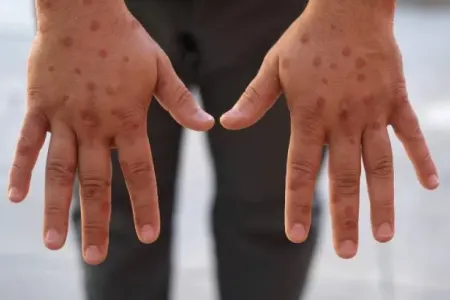 İstanbulda meymunçiçəyi - şübhəsi - VİDEO