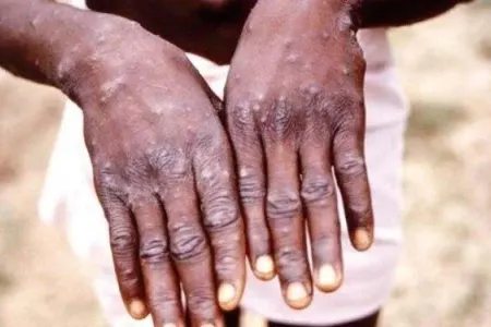 Daha bir ölkədə meymunçiçəyi - aşkarlandı