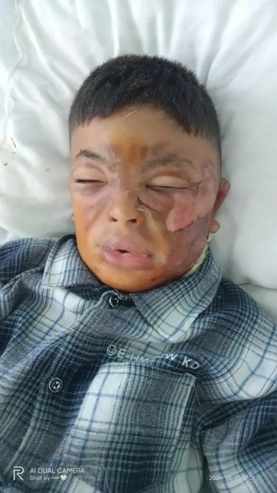 Atasına pul qazanması üçün kömək etmək istəyən səkkiz yaşlı Əbülfəz bir göz qırpımında alışıb-yandı