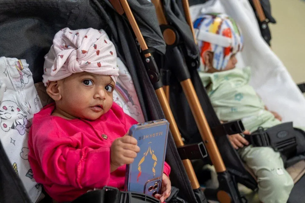 Yapışıq əkizlər 14 saatlıq əməliyyatla ayrıldı - FOTO