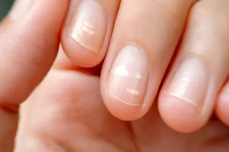 Dırnaqda ağ nöqtələrin və zolaqların yaranmasının - SƏBƏBİ