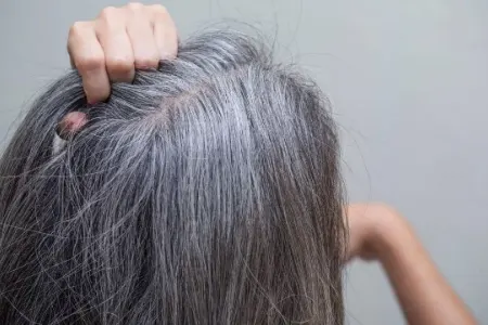 Saç ağarmasının səbəbi stressdir?