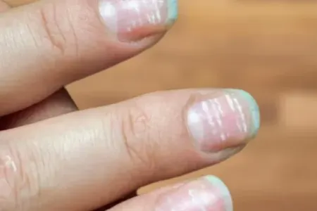 Dırnağınızdakı bu ləkə təhlükəli göstəricidir