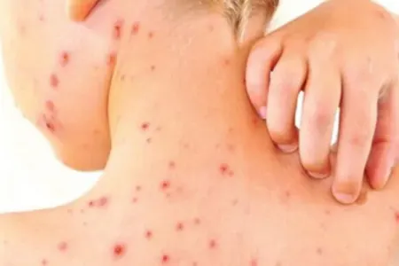 Qızılca xəstəliyi yenidən alovlanır? - RƏSMİ