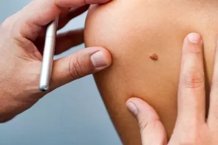 Bu əlamətlər Xərçəngdən xəbər verir