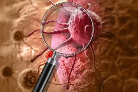 Azərbaycanda xərçəng xəstəliyi niyə sürətlə artır?