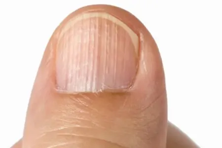 Dırnaqlardakı şaquli xətlər nə deməkdir? - vitamin çatışmazlığı...