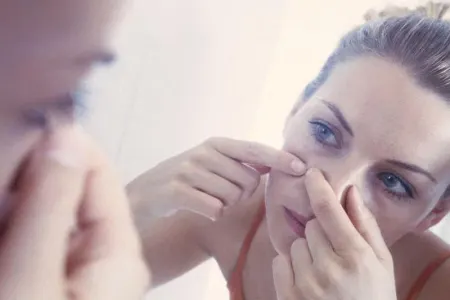 Bu qidalar sızanaq yaradır