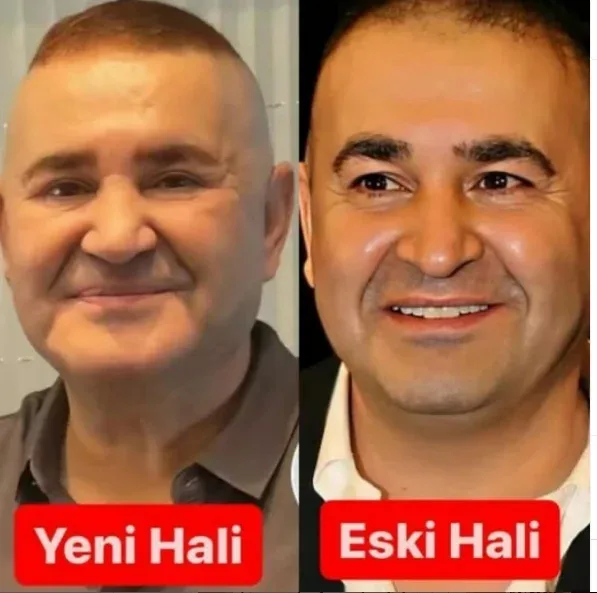 54 yaşlı aktyor əməliyyatla özünü bu hala saldı – - FOTO