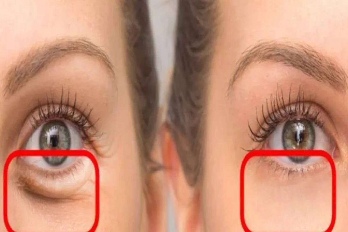 Bu su göz altındakı torbaları azaldır