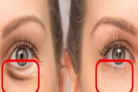 Bu su göz altındakı torbaları azaldır