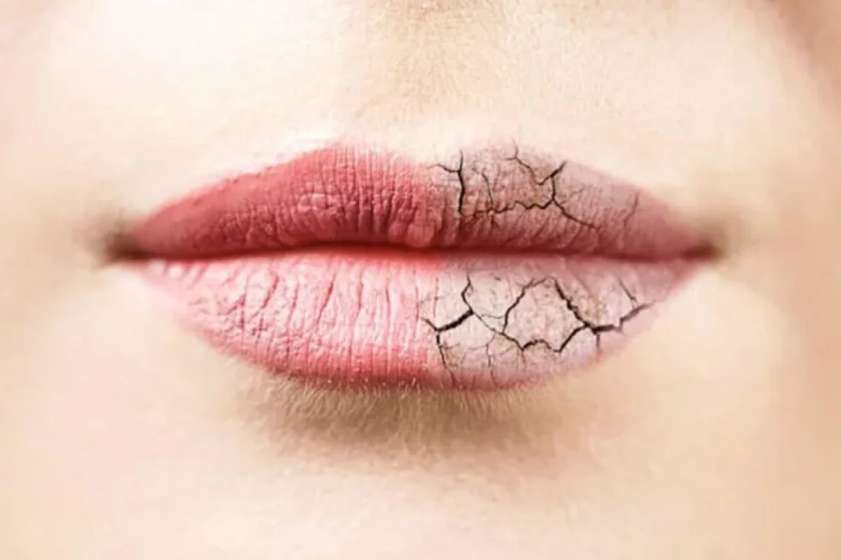 Dodaqlar payız və qışda niyə çatlayır?