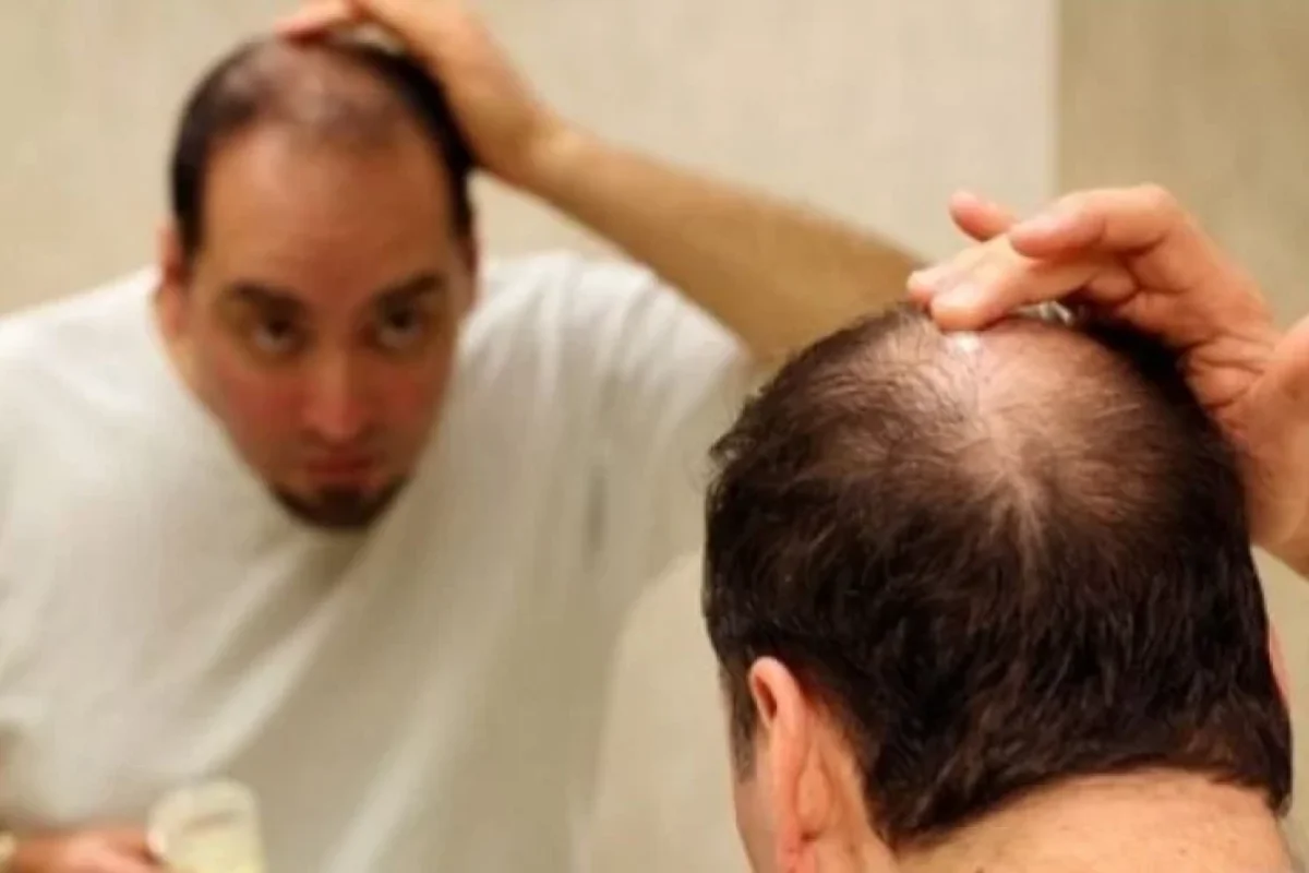 Keçəlliyin qarşısını alan üç qida - AÇIQLANDI