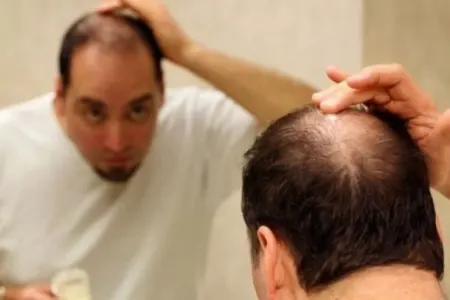 Keçəlliyin qarşısını alan üç qida - AÇIQLANDI