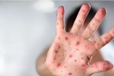 Meymunçiçəyi virusu yayılır: - Azərbaycanda vəziyyət necədir? - VİDEO