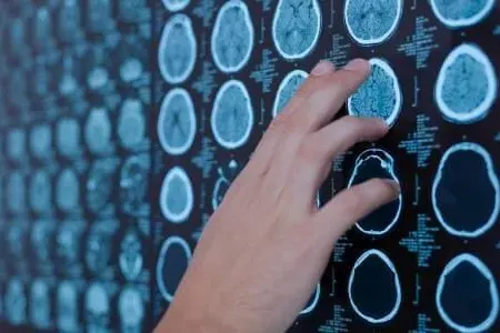 Yeni xəstəlik yayılıb - Gəncləri öldürür...