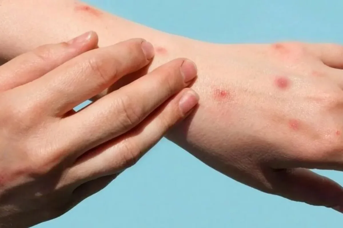 ÜST-dən meymunçiçəyi ilə bağlı qərar