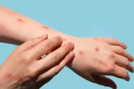 Qızılcaya yoluxma kəski artdı - .