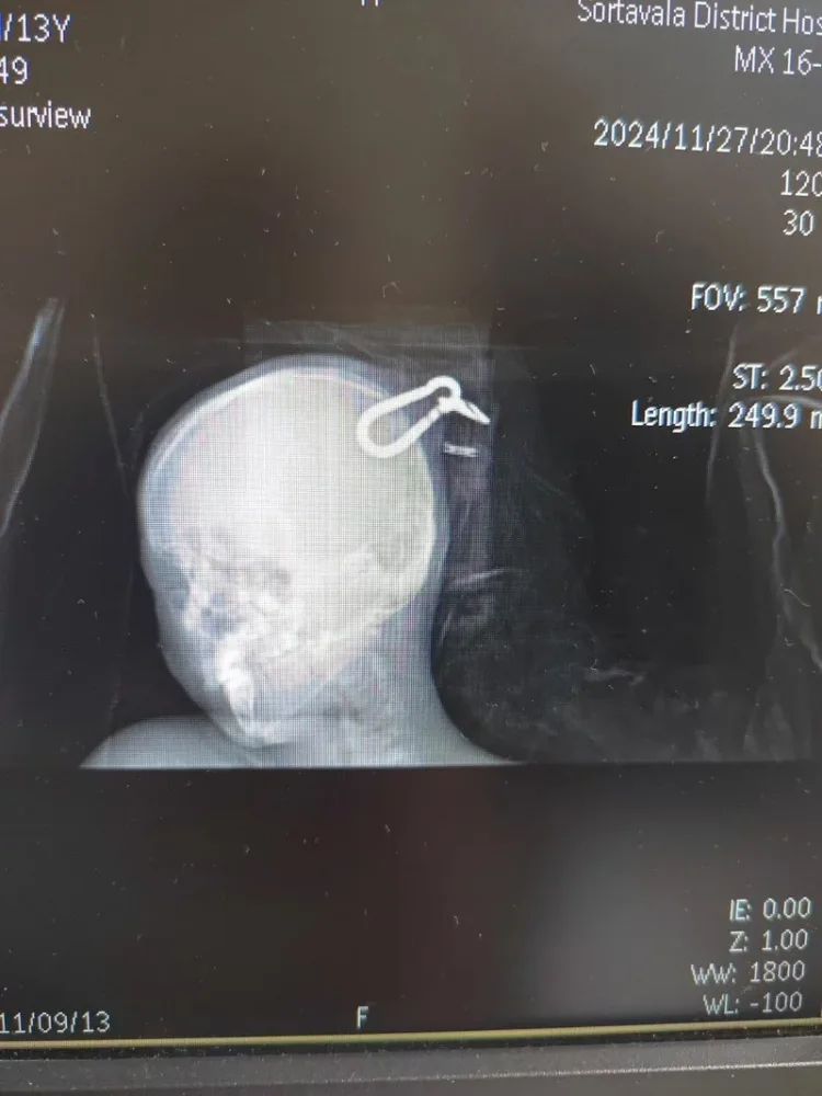 Məşq zamanı yeniyetmənin beyninə karabin - GİRDİ – FOTO