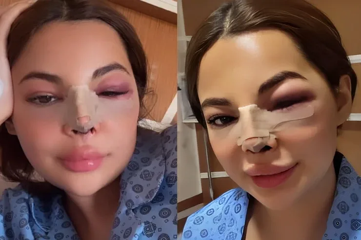 Bloqer Nuray Muxtarovanın burnu çürüdü - DOLĞU FACİƏSİ