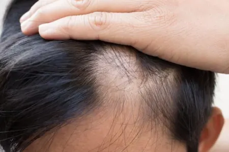 Saç əkilməsi artıq keçmişdə qaldı: Yeni müalicə metodu kəşf edildi