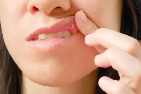 Damaqda ağ yara: Evdə necə təmizləmək olar?