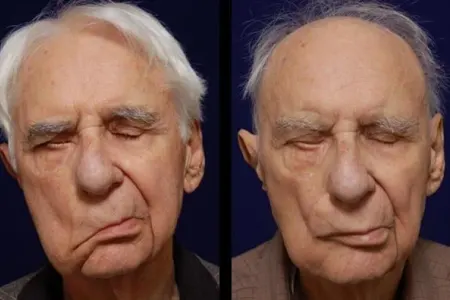 Üz sinirinin travmalarından sonra mimikanı bərpa etmək üsulu tapıldı