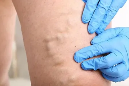 Yuxudaykən damar dartılmasının - 5 SƏBƏBİ