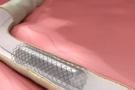 Stentə ehtiyac qalmayacaq - YENİ ÜSUL