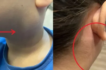 Parotit xəstəliyindən necə qorunmaq olar?