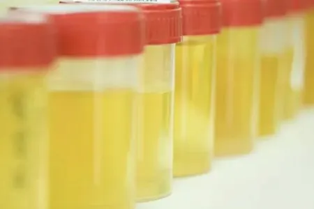 Sidiyin rəngi və qoxusu hansı xəstəliklərin göstəricisidir?