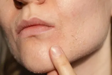 Dərimiz niyə quruyur? - Bu yolla aradan qaldırın