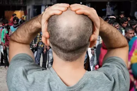 Yeni virusa yoluxanlar qəfildən keçəl olur