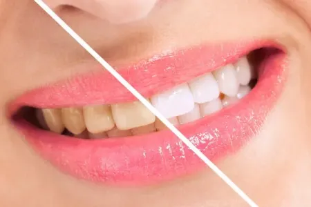 Hansı içki dişləri daha çox ləkələyir - Kola, kofe, çay yoxsa qırmızı şərab?