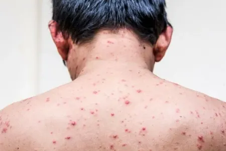 Nazirlikdən meymunçiçəyi ilə bağlı açıqlama