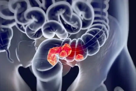 Gənclər arasında ən çox yayılan xərçənglərdən biri: - Qlobal ARAŞDIRMA__NEWL__