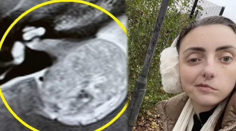 Göz səyriməsini ciddiyə alın – - Görün, nələrə səbəb oldu?