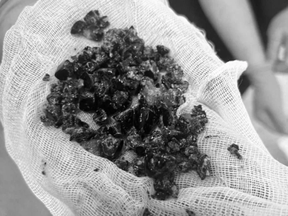 Qadının öd kisəsində GÖRÜN NƏ ÇIXDI - FOTO