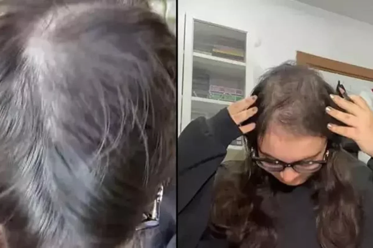 10 ildir saçlarını qoparıb köklərini yeyir - FOTO