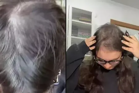 10 ildir saçlarını qoparıb köklərini yeyir - FOTO